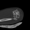 SPORK, NICO - 22.03.1976 - 02.08.2022 - CT obere Extremität - 18:02:23